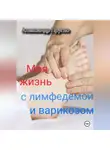 Александр Пругло - Моя жизнь с лимфедемой и варикозом